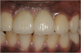 Replacement of 2 front teeth by dental implants